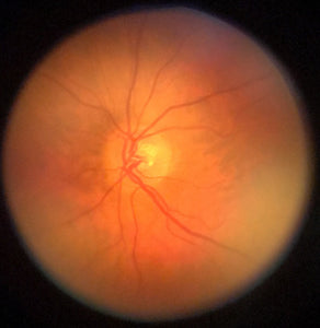 oDocs nun ophthalmoscope retinal camera